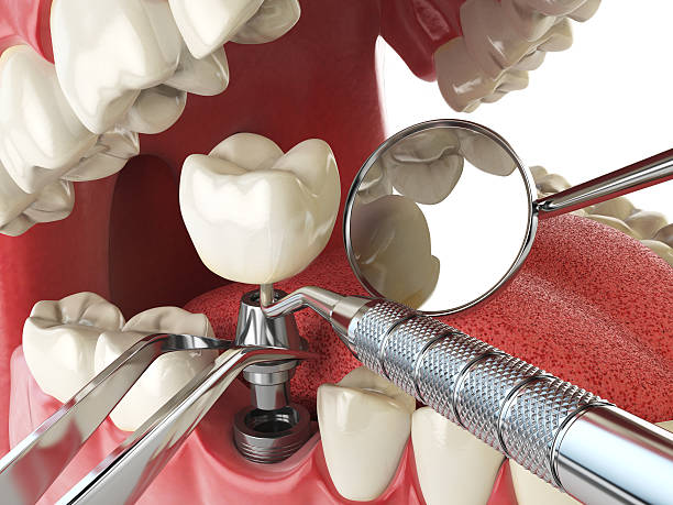 Best Emergency Dentist for Knocked-Out Tooth in Fort Pierce, FL